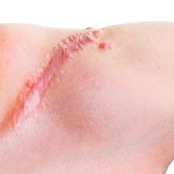 Narbenbehandlung